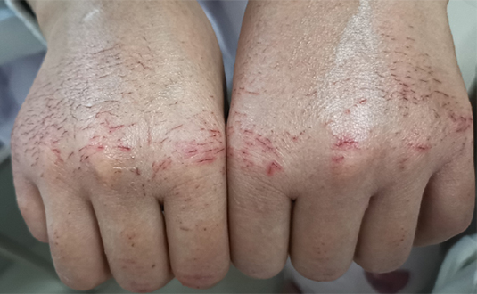 疫情中的手衛(wèi)生與手部皮膚圖片2