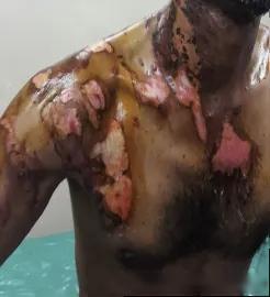 DIPHOTERINE敵腐特靈溶液印度塔拉普爾工業(yè)區(qū)化學(xué)灼傷效果評(píng)估1